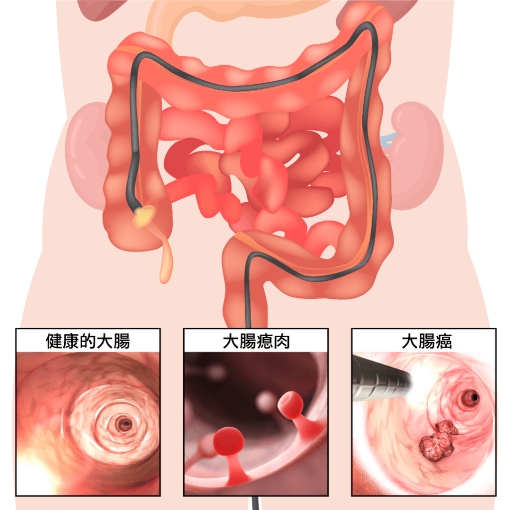 大腸鏡檢查可了解大腸內部情況及患腸癌的風險－香港著名內視鏡中心－精確醫療集團
